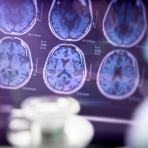 Alzheimer Hastalığı Evreleri Nelerdir ?