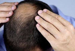 Bu yiyecekler saçlarınızı fark etmeden döküyor