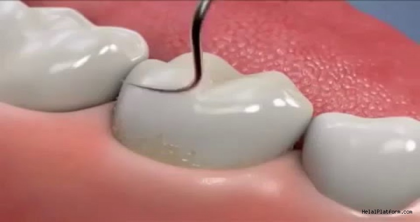 Diş taşı temizliği zararlı mıdır?