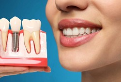 implant-tedavisinde-ust-yas-siniri-yok.jpg