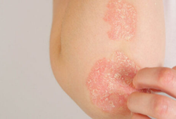 Sedef Hastalığı (Psoriasis) Nedir? Belirtileri ve Tedavi Yöntemleri