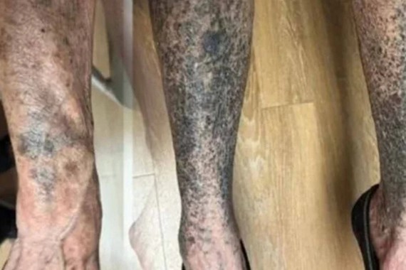 Bu ilacı kullandıktan sonra kolları ve bacakları masmavi oldu