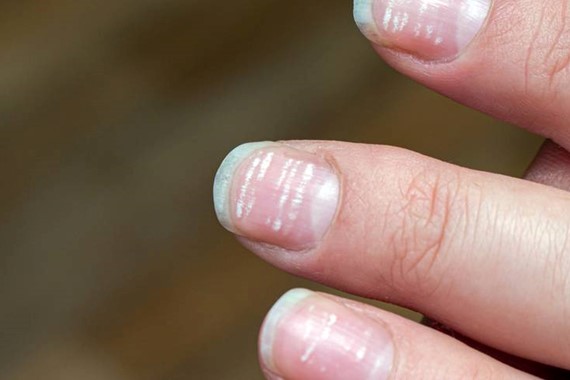 Dermatologlar Uyardı: Tırnak Altında Sonradan Çıkan Renk Değişikliği Hayati Risk Oluşturabilir!