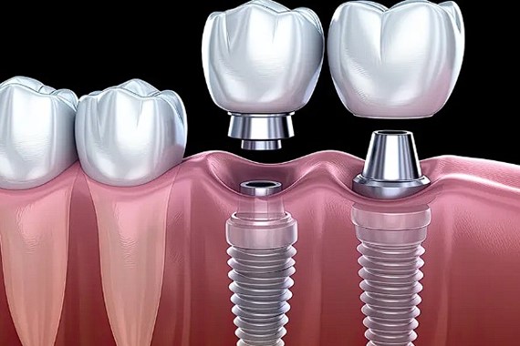 dis-implant-tedavisi-yasi.jpg