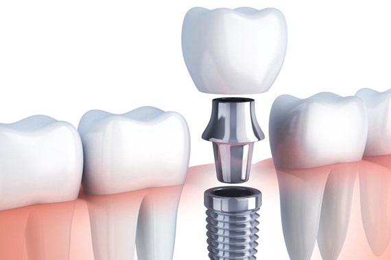 implant-tedavi-yasi-kac.jpg