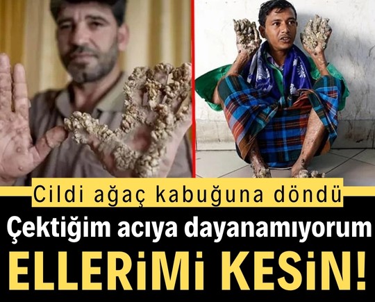 Cildi ağaç kabuğuna döndü: Çektiğim acıya dayanamıyorum, ellerimi kesin!