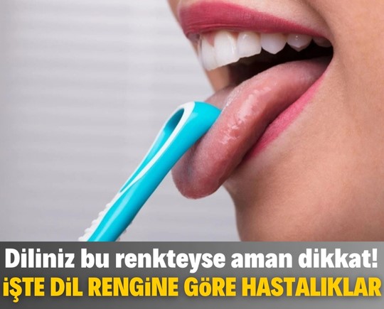 Diliniz bu renkteyse aman dikkat! İşte dil rengine göre hastalıklar!