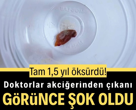 Tam 1,5 yıl öksürdü! Doktorlar akciğerinden çıkanı görünce şok oldu